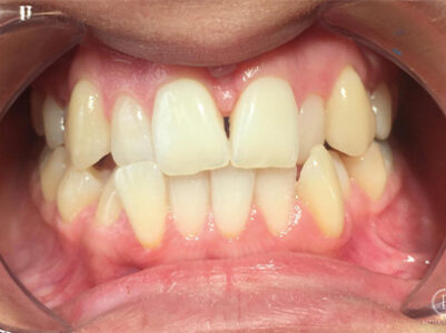 Before - Brixtonsmiles