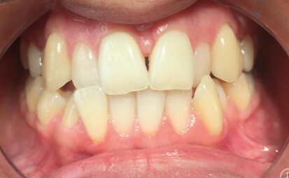 Before - brixtonsmiles