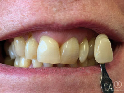 Before - Brixtonsmiles