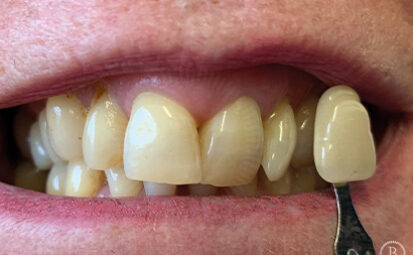 Before - brixtonsmiles