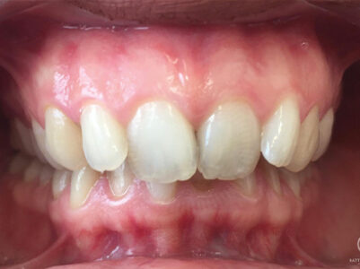 Before - Brixtonsmiles