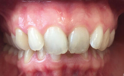 Before - brixtonsmiles