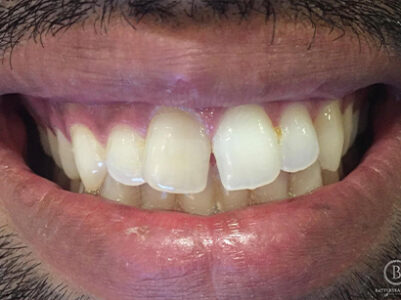 Before - Brixtonsmiles