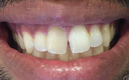 Before - brixtonsmiles