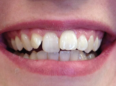 Before - Brixtonsmiles