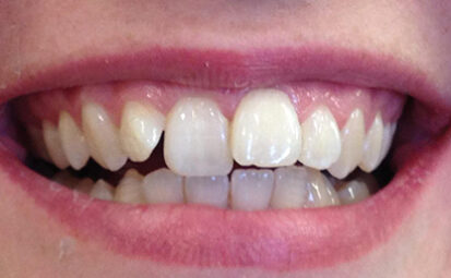 Before - brixtonsmiles