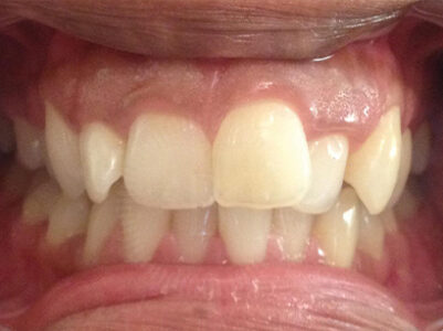 Before - Brixtonsmiles