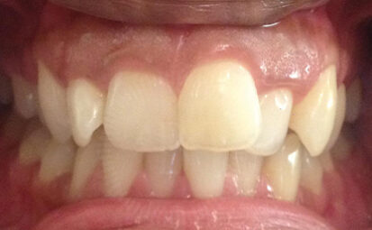 Before - brixtonsmiles