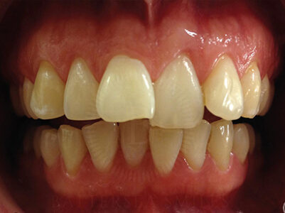 Before - Brixtonsmiles