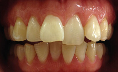 Before - brixtonsmiles